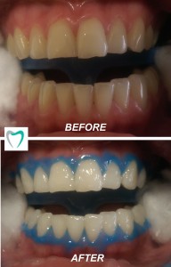 amazing teeth whitening results