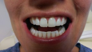 Laser Teeth Whitening - June 2014