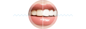 teeth-whitening-results