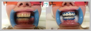 Laser Teeth Whitening result 04