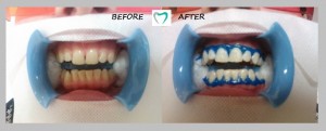 teeth whitening - result 02